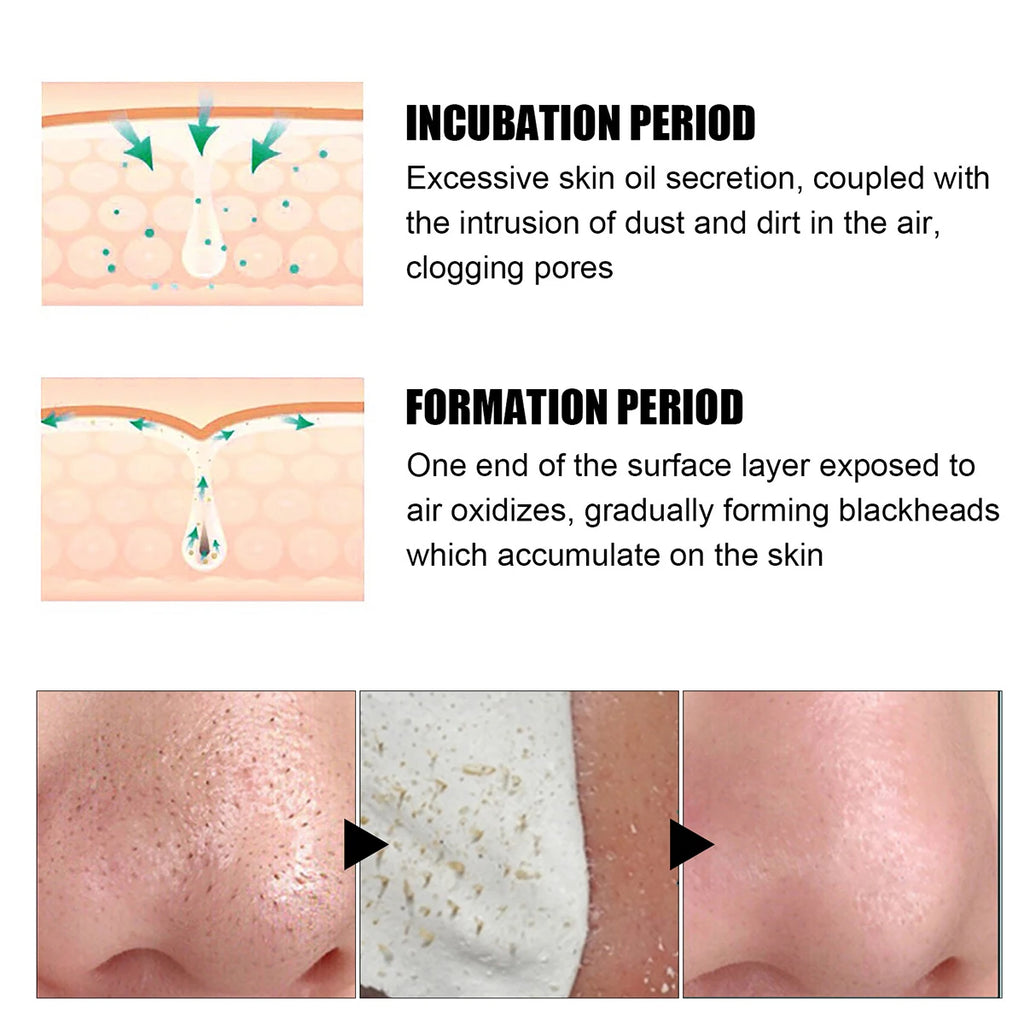 Blackhead Nose Patch – Deep Cleansing Pore Strip | HIP Blackhead Pore Strip HIP