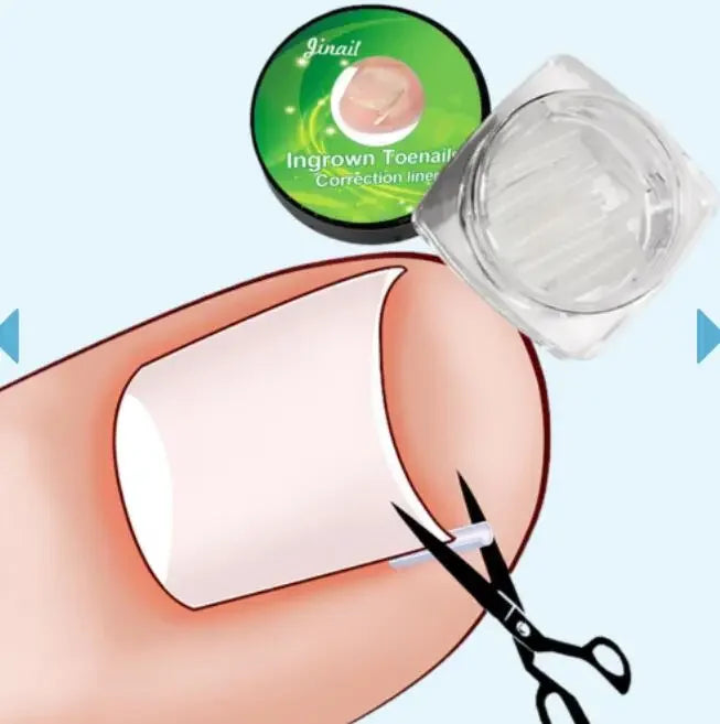 Ingrown Toenail Correction Patches – Ultra-Thin Elastic Stickers Toenail Correction Patch HIP