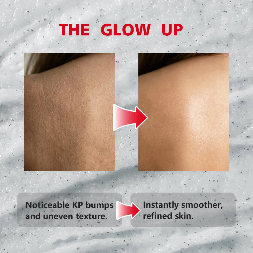 KP Bump Eraser Body Scrub Keratosis Pilaris Skin Exfoliator Helps Reduce Chicken Bumps Exfoliate to Reduce Dullness Skin Care HIP