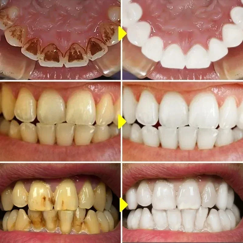 Teeth Whitening Serum – Remove Stains & Freshen Breath Teeth Whitening Serum HIP
