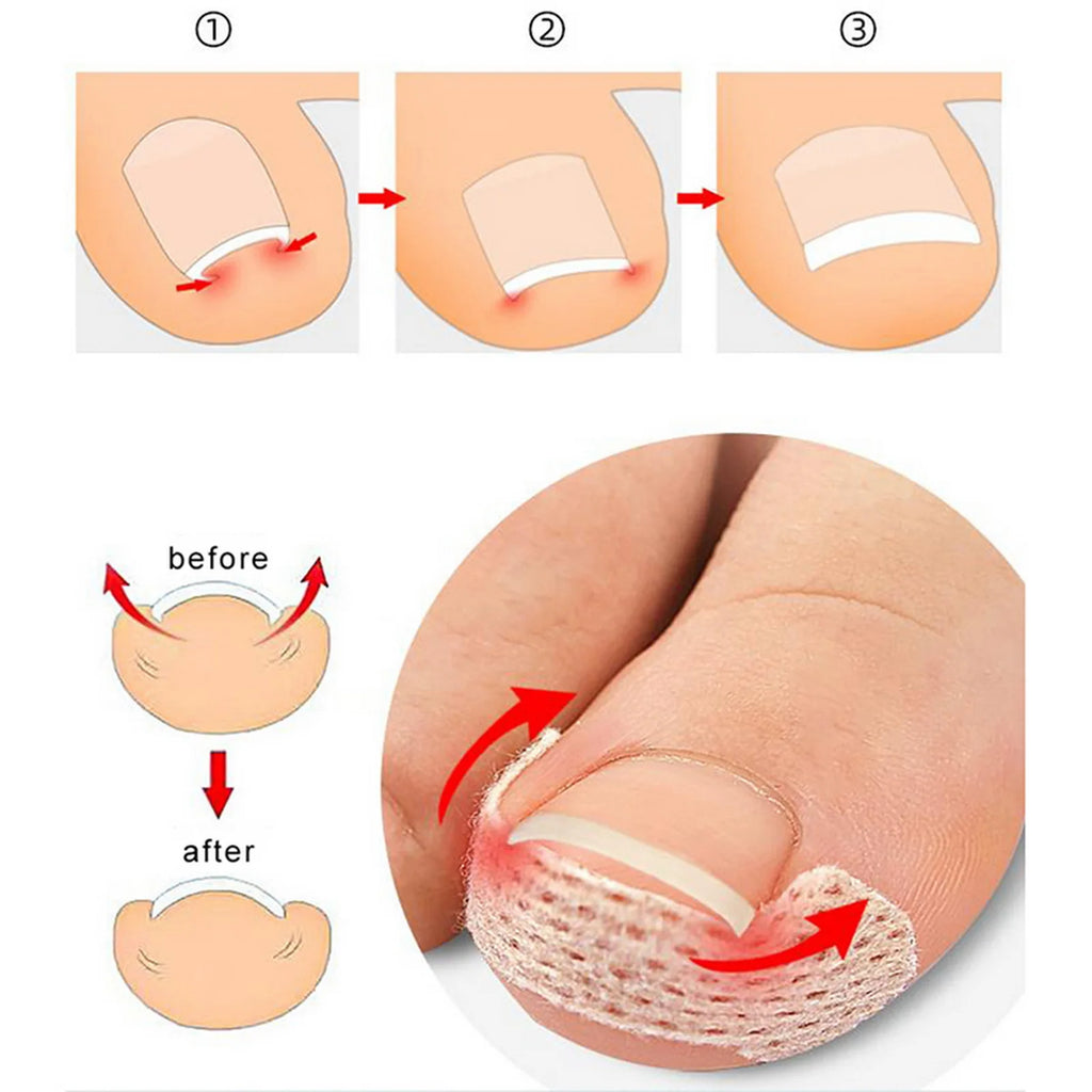 Ingrown Nail Breathable Patches – 10/30/50/100 Pcs | HIP Nail Care Patch HIP