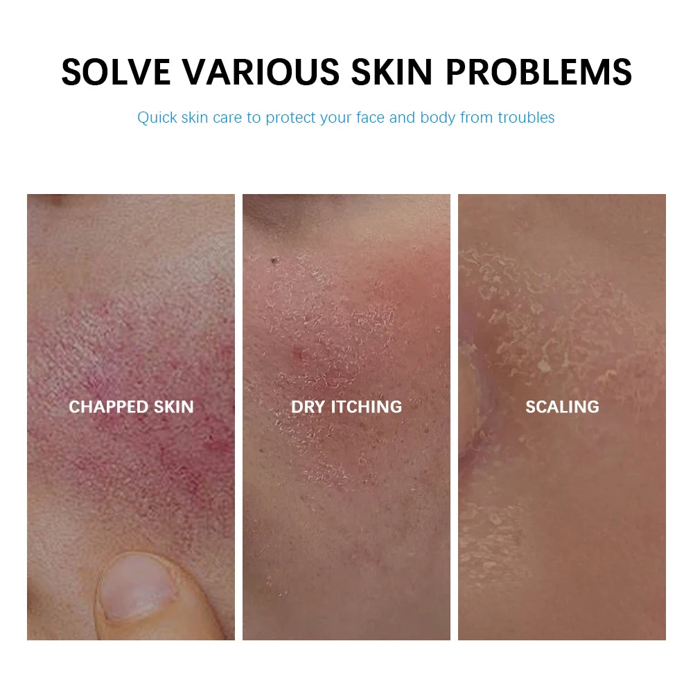 Soothing Multi-Purpose Hydrating Cream Reduces Redness Daily Helps Relieve Rough Cracked Skin Deep Skin Care HIP
