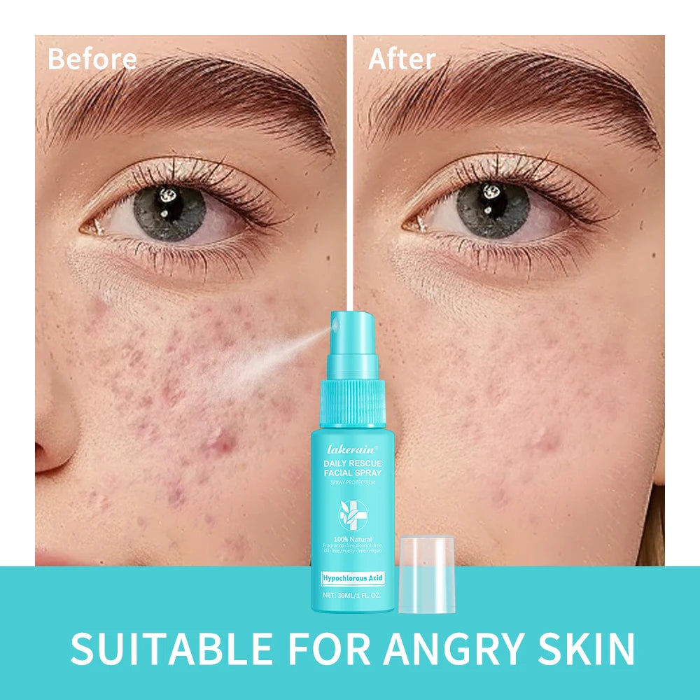 PH Balancing Toner Daily Rescue Facial Spray for Sensitive Skin Hypochlorous Acid Spray Helps Reduce Redness Breakouts Soothing HIP