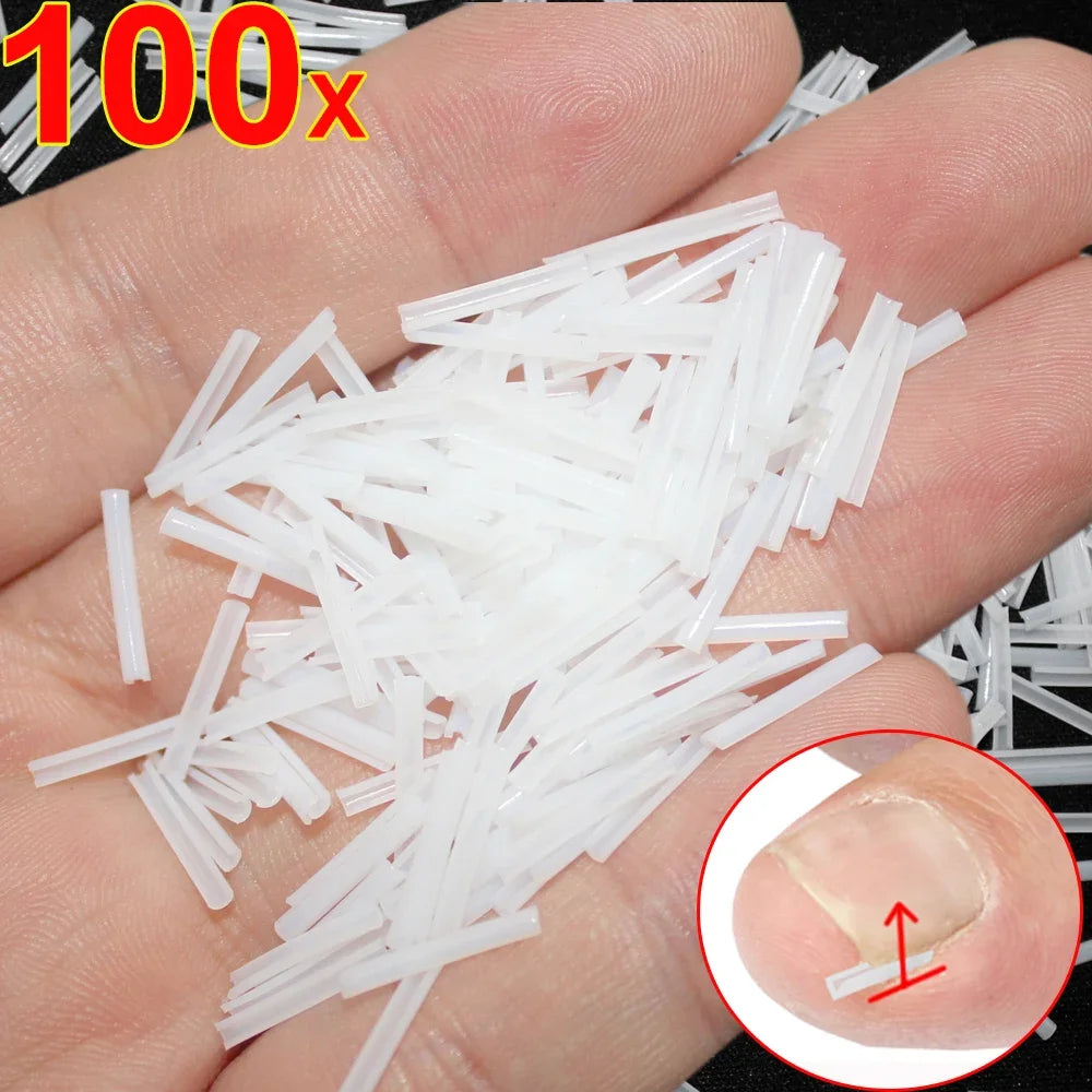Ingrown Toenail Correction Patches – Ultra-Thin Elastic Stickers Toenail Correction Patch HIP