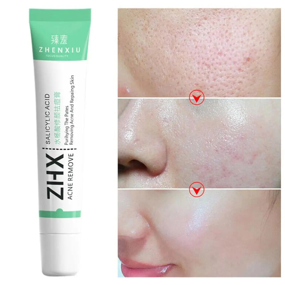 Salicylic Acid Pore Refining Cream – Blackhead & Smooth Skin Pore Refining Cream HIP