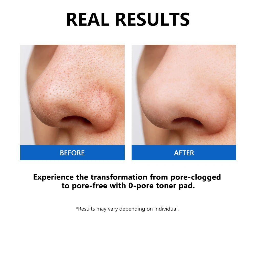 Zero Pore Toner Pads Control Oil Reduce Sebum Exfoliate Deep Clean Refines Pores Antioxidant Skincare Treatment skincare korean HIP