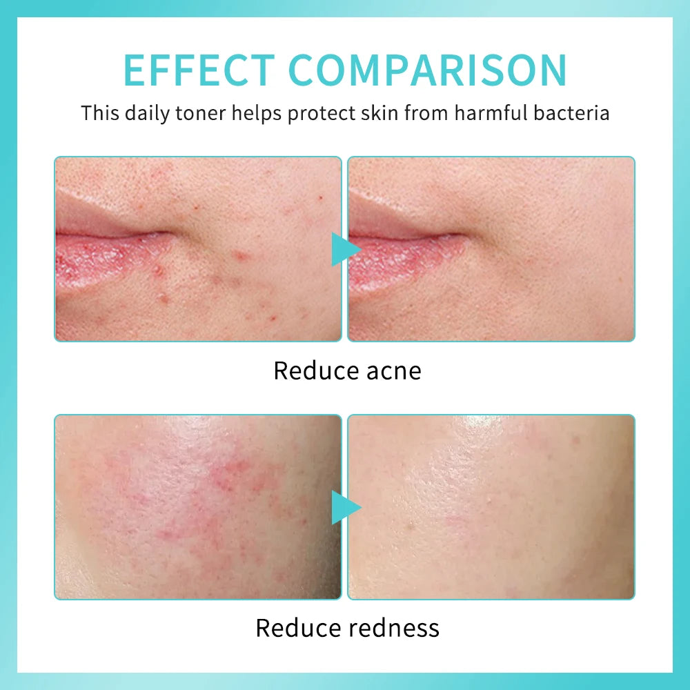PH Balancing Toner Daily Rescue Facial Spray for Sensitive Skin Hypochlorous Acid Spray Helps Reduce Redness Breakouts Soothing HIP