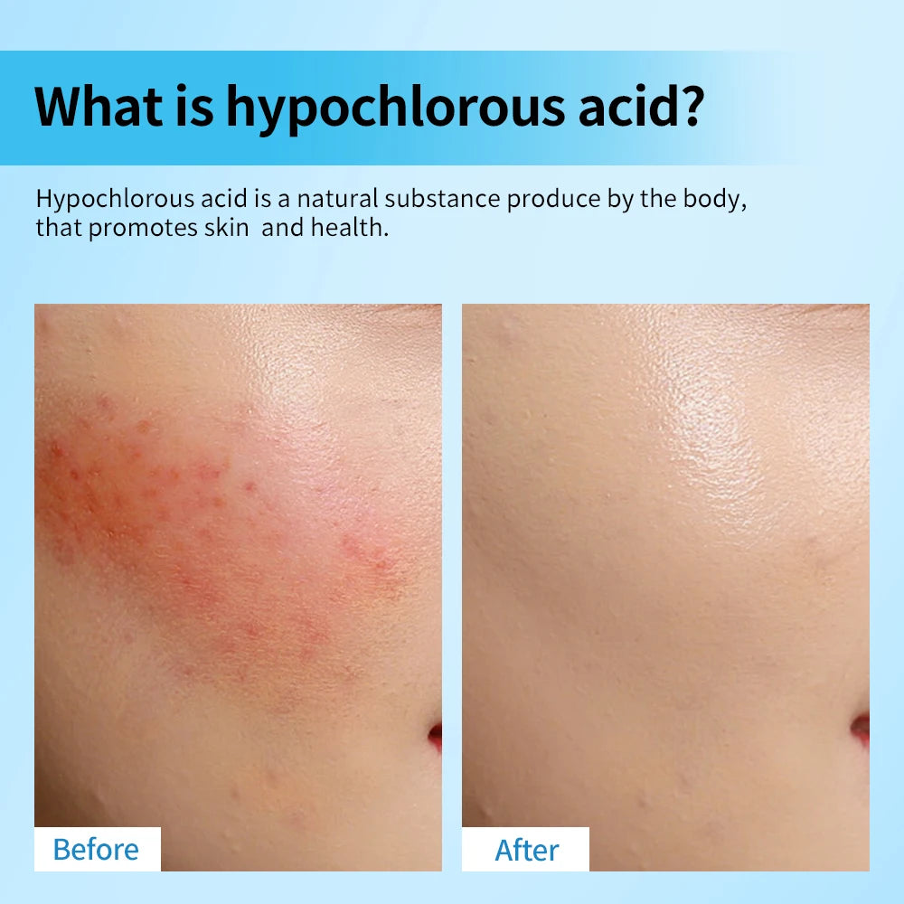 Hypochlorous Acid Facial Spray Reduce redness swelling acne Versatile uses for every skin Calm Redness Eyelid lrritation Care Sk HIP